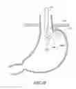 Fig. 10 - Devices and methods for endolumenal gastrointestinal bypass