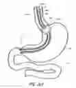 Fig. 14 - Devices and methods for endolumenal gastrointestinal bypass