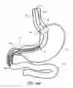 Fig. 15 - Devices and methods for endolumenal gastrointestinal bypass