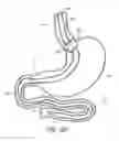 Fig. 16 - Devices and methods for endolumenal gastrointestinal bypass