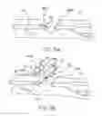 Fig. 10 - Device for rapid repair of body conduits