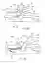 Fig. 19 - Device for rapid repair of body conduits