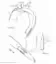Fig. 50 - Delivery system and method for self-centering a Proximal end of a stent graft