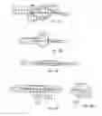 Fig. 61 - Delivery system and method for self-centering a Proximal end of a stent graft