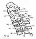 Fig. 19 - Flexible implant