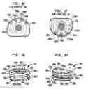 Fig. 03 - System for inserting artificial intervertebral discs