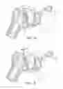 Fig. 02 - Adaptor prosthesis kit