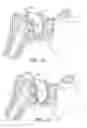 Fig. 03 - Adaptor prosthesis kit