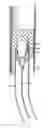 Fig. 01 - Kit for implanting in a duct