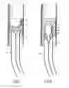 Fig. 04 - Kit for implanting in a duct