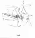 Fig. 06 - DROPLET COLLECTION DEVICES AND METHODS TO DETECT AND CONTROL AIRBORNE COMMUNICABLE DISEASES UTILIZING RFID