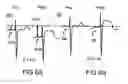 Fig. 06 - Baseline correction in systems for detecting ischemia