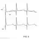 Fig. 09 - Baseline correction in systems for detecting ischemia