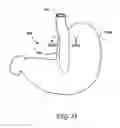 Fig. 22 - Obesity treatment tools and methods