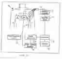 Fig. 03 - Method and apparatus for the guided ablative therapy of fast ventricular arrhythmia