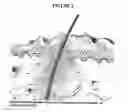 Fig. 03 - Compositons and methods for maintaining eyelid hygiene