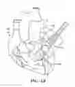 Fig. 17 - Shock Wave Treatment Device