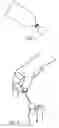 Fig. 03 - Ingrown toenail treatment method