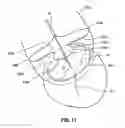 Fig. 08 - Activation device for dynamic ring manipulation