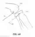 Fig. 10 - Surgical Device for Anterolateral and Posterolateral Reconstruction