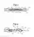 Fig. 03 - EMBOLUS EXTRACTOR