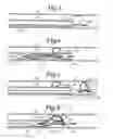 Fig. 04 - EMBOLUS EXTRACTOR