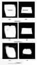 Fig. 02 - Implantable medical device with material for reducing MRI image distortion