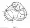 Fig. 02 - Annuloplasty device having a helical anchor and methods for its use