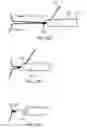 Fig. 17 - Annuloplasty device having a helical anchor and methods for its use