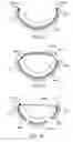 Fig. 20 - Annuloplasty device having a helical anchor and methods for its use