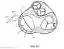 Fig. 23 - Annuloplasty device having a helical anchor and methods for its use