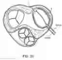 Fig. 25 - Annuloplasty device having a helical anchor and methods for its use