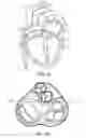 Fig. 26 - Annuloplasty device having a helical anchor and methods for its use
