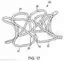 Fig. 06 - Device and method for establishing an artificial arterio-venous fistula