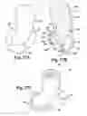 Fig. 35 - Devices and methods for treatment of obesity