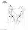 Fig. 02 - Electrical stimulation of ilioinguinal nerve to alleviate chronic pelvic pain