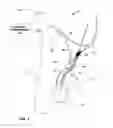Fig. 03 - Electrical stimulation of ilioinguinal nerve to alleviate chronic pelvic pain