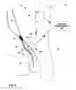 Fig. 10 - Electrical stimulation of ilioinguinal nerve to alleviate chronic pelvic pain