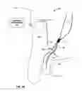 Fig. 14 - Electrical stimulation of ilioinguinal nerve to alleviate chronic pelvic pain