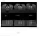 Fig. 08 - COMPOSITIONS AND METHODS FOR CONVECTION ENHANCED DELIVERY OF HIGH MOLECULAR WEIGHT NEUROTHERAPEUTICS