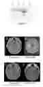 Fig. 06 - Compositions and Methods Relating to CNS Lymphoma