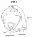 Fig. 02 - Apparatus and method for suturelessly connecting a conduit to a hollow organ