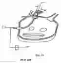 Fig. 02 - Catheter and method for ablation of atrial tissue