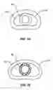 Fig. 03 - Transformable spinal implants and methods of use