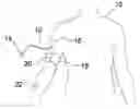 Fig. 01 - Device for retaining the external portion of a peripherally inserted central catheter