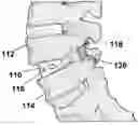 Fig. 01 - Use of bioabsorbable materials for anterior extradiscal correction of thoracolumbar pathologies