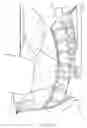 Fig. 06 - Use of bioabsorbable materials for anterior extradiscal correction of thoracolumbar pathologies