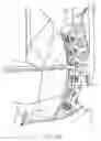Fig. 08 - Use of bioabsorbable materials for anterior extradiscal correction of thoracolumbar pathologies