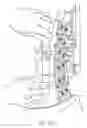 Fig. 10 - Use of bioabsorbable materials for anterior extradiscal correction of thoracolumbar pathologies