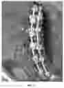 Fig. 12 - Use of bioabsorbable materials for anterior extradiscal correction of thoracolumbar pathologies